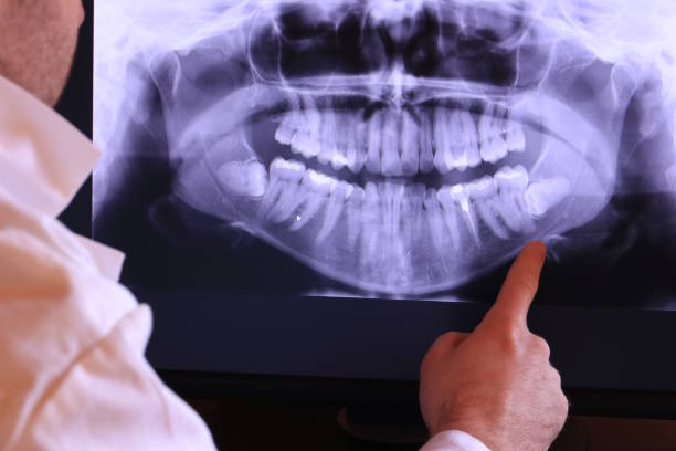 Best Emergency Tooth Extraction in Berlin, NJ